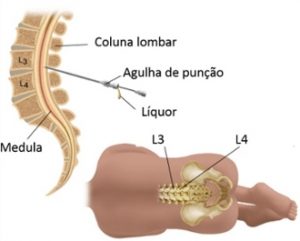 Tap Teste TAP test - Clínica Regenerati - Neurologia