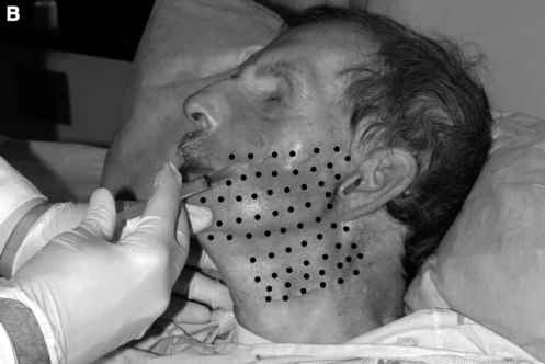 botox-dor-neuropatica Toxina Botulínica Terapêutica