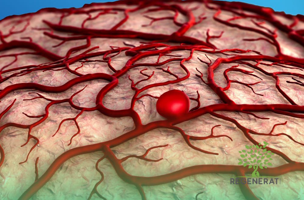 Aneurisma Cerebral