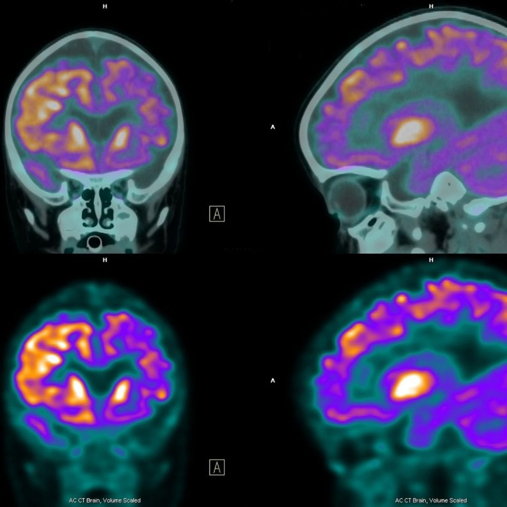 Tratamento da Epilepsia – Cirurgias