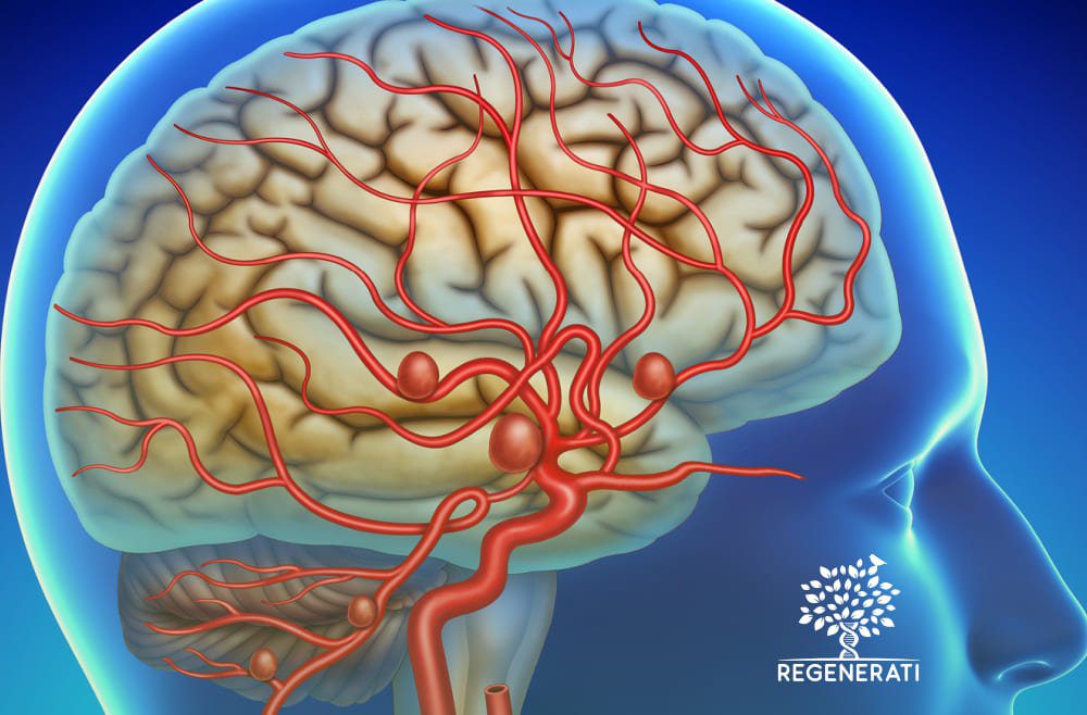 Localização e Causas de um Aneurisma Cerebral