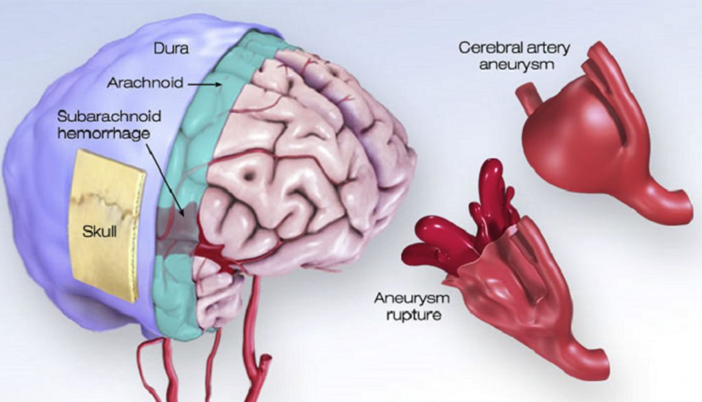 Emorragia cerebrale perso pezzo cranio