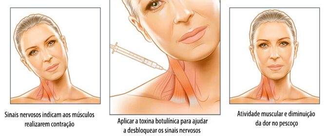 Toxina Botulínica/Botox para Bruxismo - Masseter - Dermatologista