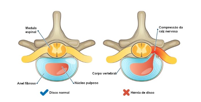 Compressão de raiz nervosa cervical