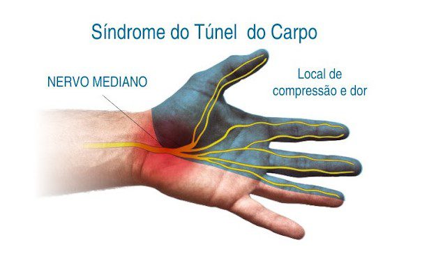 Dor e Dormência Nas Mãos