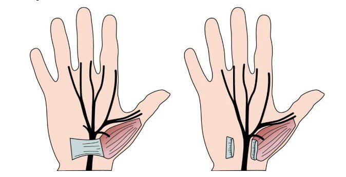 Dor e Dormência Nas Mãos
