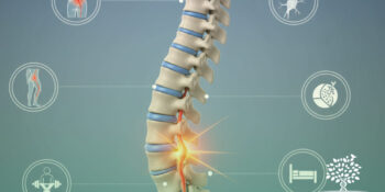 Hérnia de Disco – Tudo que Você Precisa Saber Sobre a Dor da Hérnia